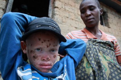Albinos in Burundi. Foto: Flickr/Alex Wynter - IFRC - International Federation of Red Cross and Red Crescent Societies.