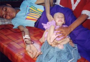 Bambino malnutrito con la mamma malata di TBC
